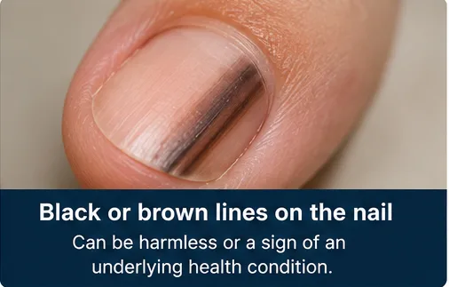 Black or brown lines on the nail, which can be harmless or a sign of an underlying condition