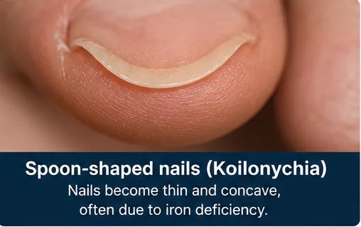 Spoon-shaped nails (Koilonychia) often linked to iron deficiency