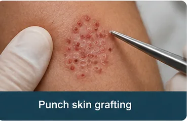 Punch skin grafting technique used for skin repair