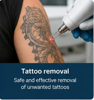 Laser tattoo removal treatment being performed on the arm