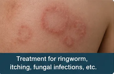 Ringworm and fungal skin infection on the shoulder before treatment